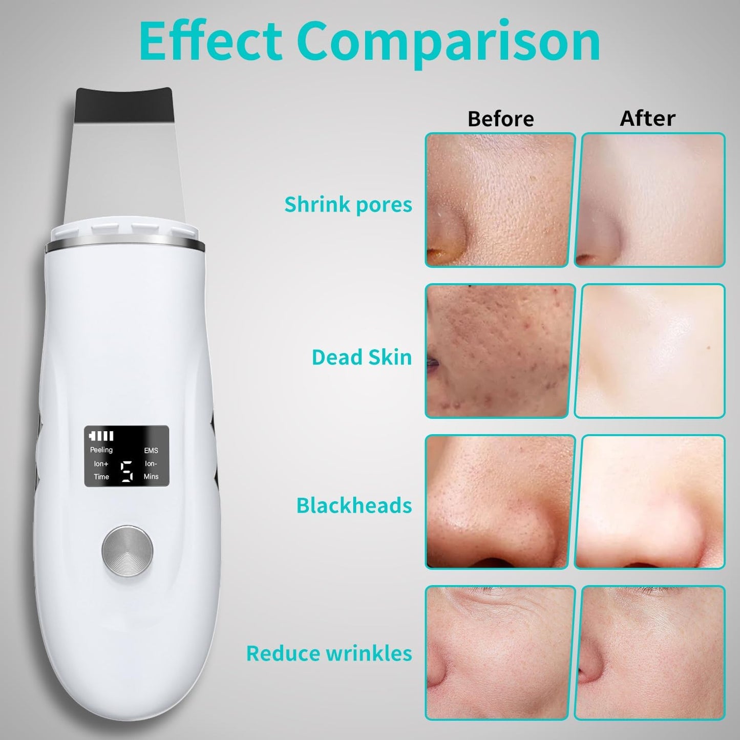 4-in-1 Ultrasonic Skin Spatula Face Scrubber – Deep Pore Blackhead Remover (White)
